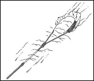 Figure 10-18. Horshoe or bollard anchor.